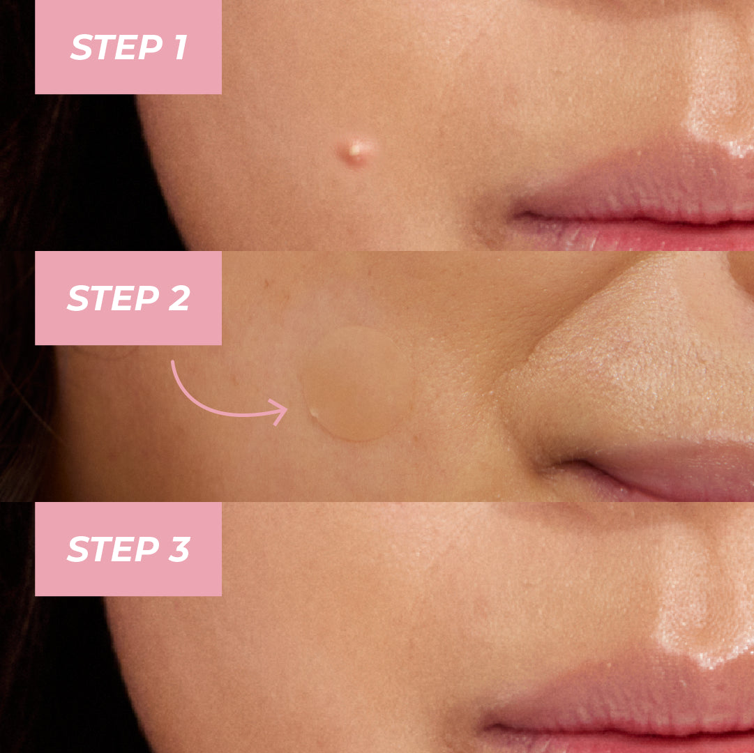 MCoBeauty Miracle Pimple Patches - 36pk
