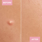 MCoBeauty Miracle Pimple Patches - 36pk